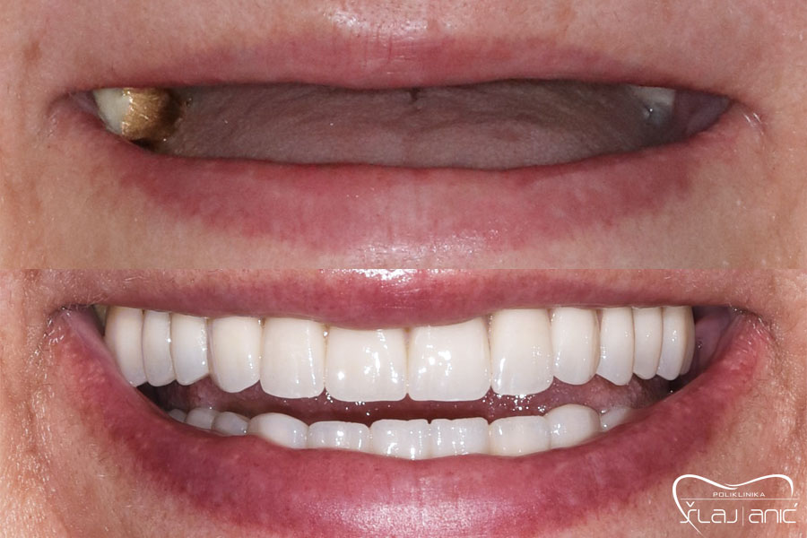 Prikaz all on 4 sustava u ustima pacijenta, gornja polovica slike pokazuje bezuba usta prije a donja prikazuje zube nakon instalacije sustava