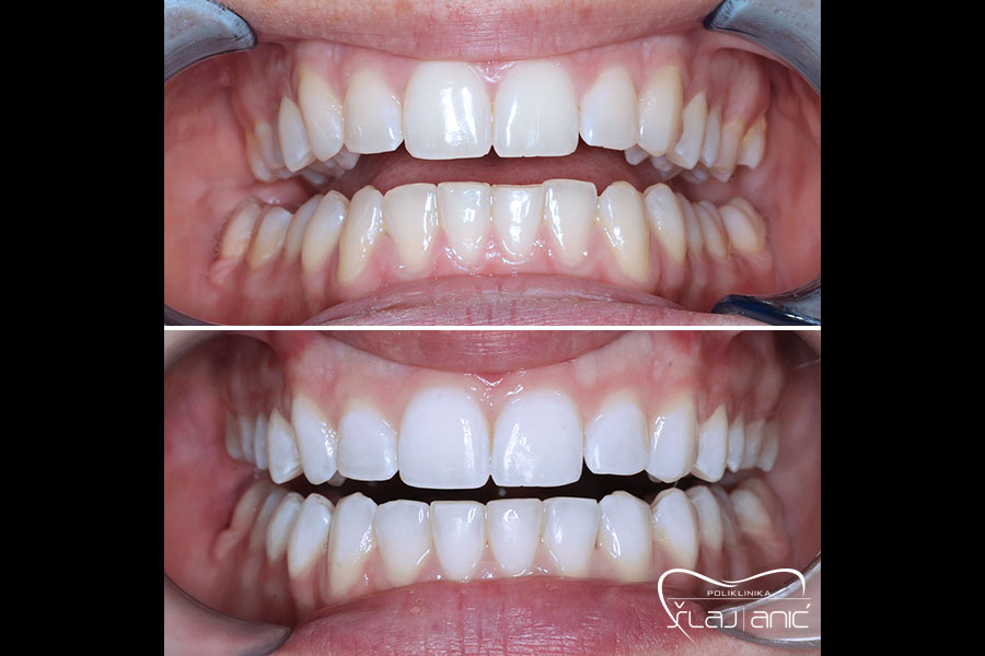 Pokazni slučaj izbjeljivanje zubi, gornja polovica slike pokazuje gornju i donju vilicu prije a donja poslije zahvata
