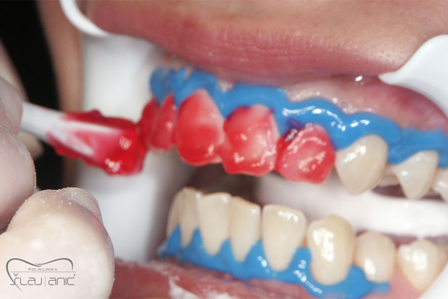 Pokazni slučaj, pacijentovi zubi se premazuju medicinskim sredstvom koje pomaže izbjeljivanje zubi