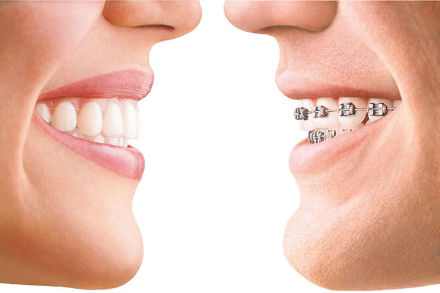 Slika dvaju nasmiješenih usta iz profila, okrenutih jedno nasuprot drugom, lijeva nose prozirni inivsalign aparatić za zube a desna nose metalni aparatić za zube